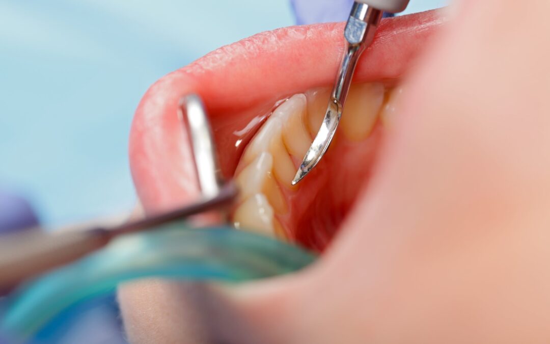 opérations des dents avec outils