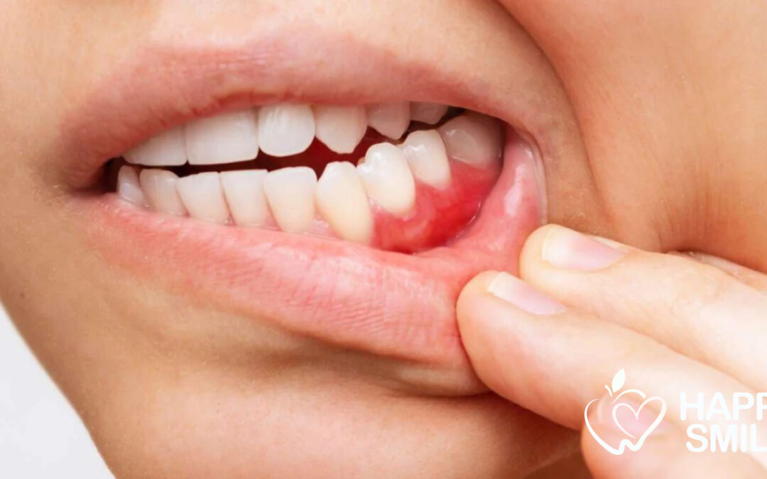 maintien parodontal pour éviter les gencive irritées