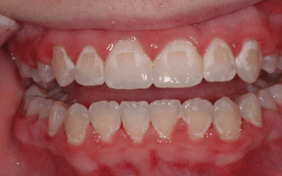 Taches Blanches sur les Dents : Causes, Traitements et Prévention