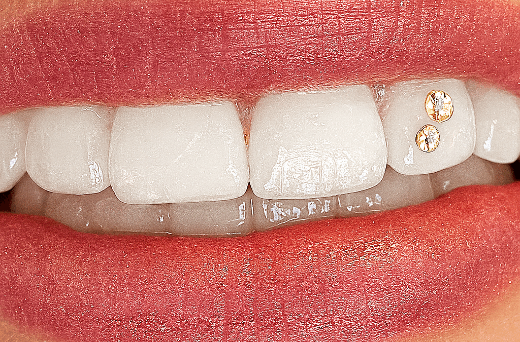 Pose de Strass Dentaire à Lausanne : Éclat, Sécurité et Personnalisation avec Happy Smile