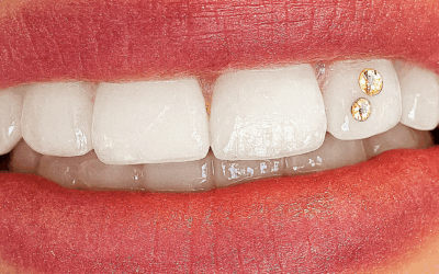 Pose de Strass Dentaire à Lausanne : Éclat, Sécurité et Personnalisation avec Happy Smile